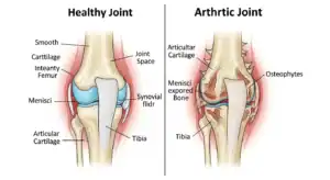 Simple diagram showing healthy joint vs. arthritic joint